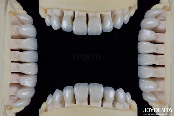 Keramik Untuk Estetika Alami Veneers Gigi Tahan noda Mempertahankan Kecerahan Ikatan yang Kuat Dengan Enamel Gigi Untuk Pas Aman