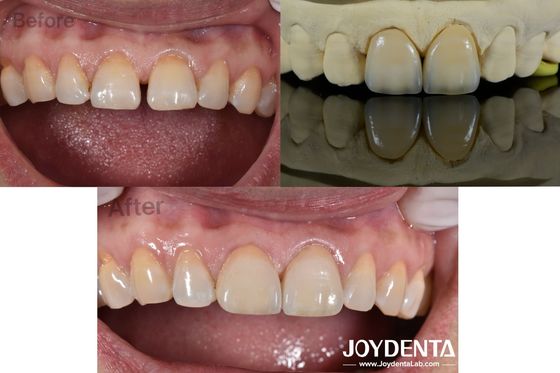 0.5mm Ketebalan veneer gigi Permeabilitas sempurna veneer porselen untuk gigi celah
