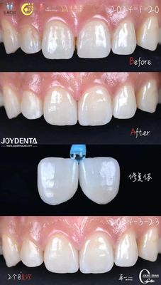 Indikasi gigi depan veneer gigi tanpa persiapan yang diperlukan dan tanpa perubahan warna