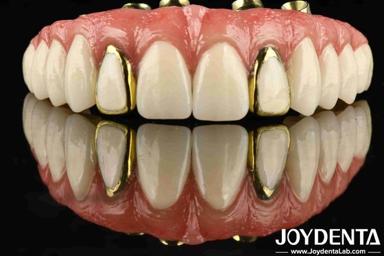 Pengalaman Ketahanan Titanium Malong Hybrid Jembatan Untuk Dentistry Terapan