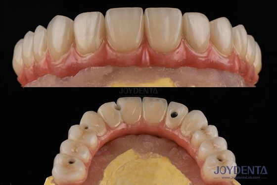 Beli Permukaan kasar Dental Implantasi Dental Platform Jembatan Dental Dengan Sambungan Internal pembuatan online