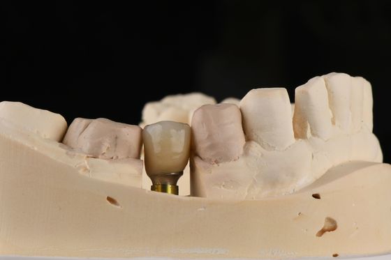 Beli Implantasi Gigi Tunggal dengan Benang Self-Tapping dan Sambungan Hex Internal pembuatan online