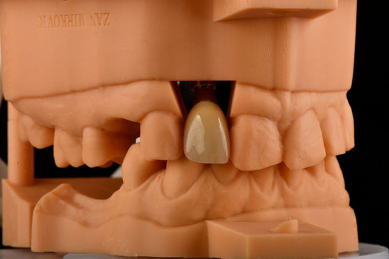 Beli Hex internal 3,0mm kedalaman 1,5mm pitch tunggal titanium gigi implan penggantian pembuatan online