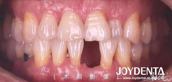 Beli Jembatan resin Maryland yang dapat disesuaikan untuk gigi anterior dan premolar pembuatan online