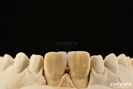 Beli 0.2mm Ketebalan Microthin Veneers Glass Ceramic Dental Veneers Untuk Gigi Depan pembuatan online