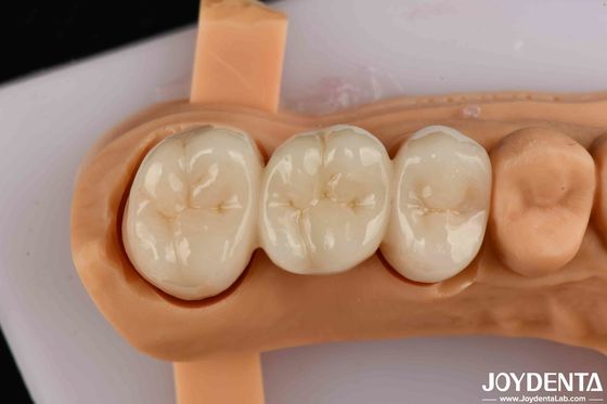 Beli Kekuatan Flexural Tinggi Zirconia Full Contour Untuk Mahkota Jembatan Restorasi Gigi pembuatan online