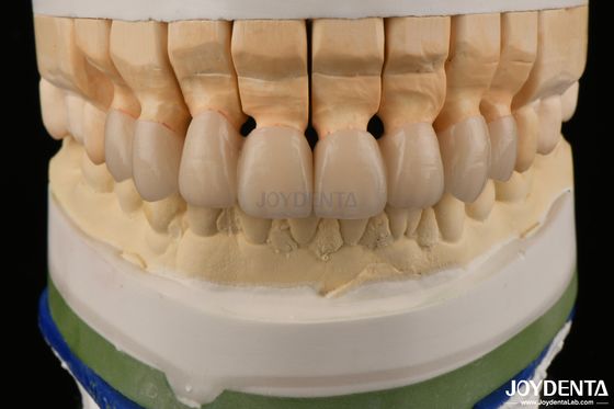 Beli Pencitraan Translucence Tinggi Zirconia berlapis Mahkota Jembatan Restorasi gigi Penampilan yang nyata pembuatan online