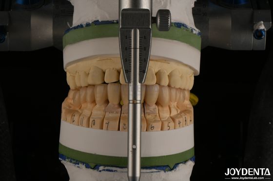 Beli Tinggi Estetika Porselen Lapisan Zirconia Gigi Untuk Restorasi Implan pembuatan online
