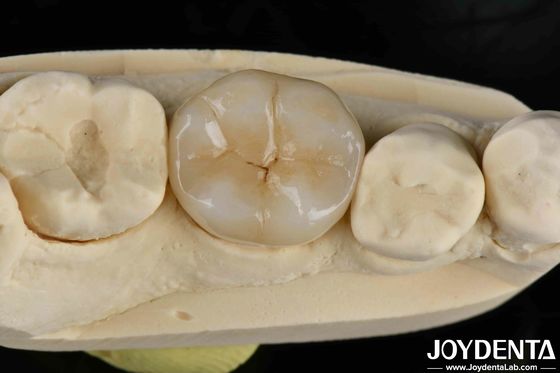 Beli Cementasi Adesif Zirconia Inlay Gigi Dan Onlays Tampilan Alami pembuatan online