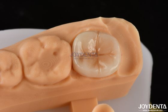Beli 0.5mm-2mm Precise Fit Emax Dental Inlay Onlay Untuk Restorasi Gigi yang andal pembuatan online