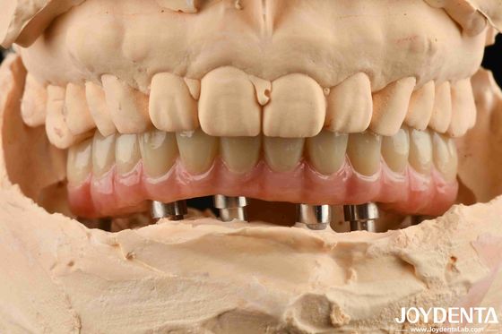 Beli Titanium Malong Hybrid Dental Implant Bridge Untuk Kesempurnaan Gigi pembuatan online