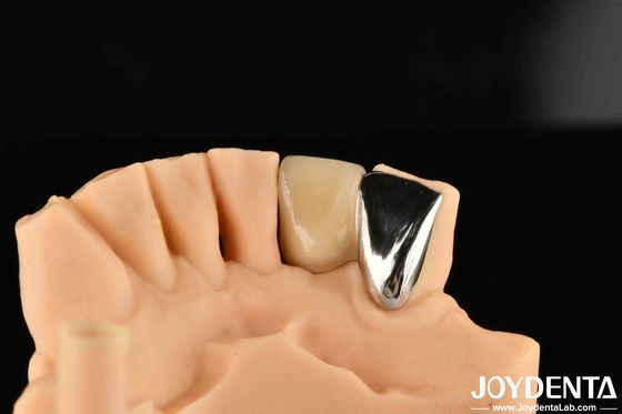 Beli Dental Metal / Maryland Bridege Perbaikan Klinik Oral Metallik Warna Ideal Ikatan Klinis pembuatan online