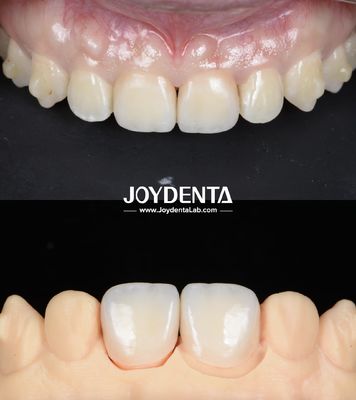 Beli Jembatan Gigi Zirconia Permukaan Lempar Ringan Untuk Restorasi yang Didukung Implan pembuatan online