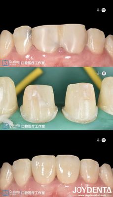 Beli Gigi yang cocok dengan sempurna Zirconia Mahkota Gigi Dengan Sistem CAD CAM Untuk Manufaktur Presisi pembuatan online