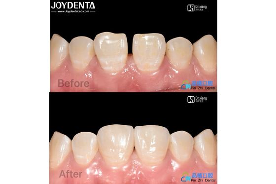 Beli Aman Pas Porselen veneers Perawatan gigi Komposit resin veneers tahan noda pembuatan online