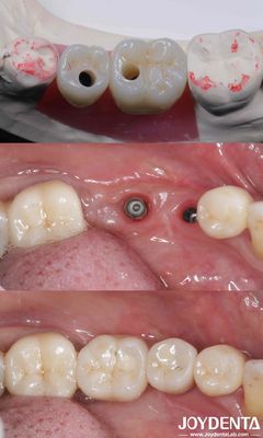 Beli Silinder All On 4 Titanium Implantasi Gigi 10-16mm Panjang Hex Sambungan pembuatan online