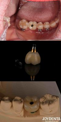 Beli 4-6 Dental Endosseous Conical Implant Subcrestal Bone Level dan Internal Hex Connection pembuatan online