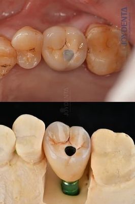 Beli Titanium Full Arch Dental Implants Platform Prosthetic 4.1mm Untuk Ketahanan Luar Biasa pembuatan online