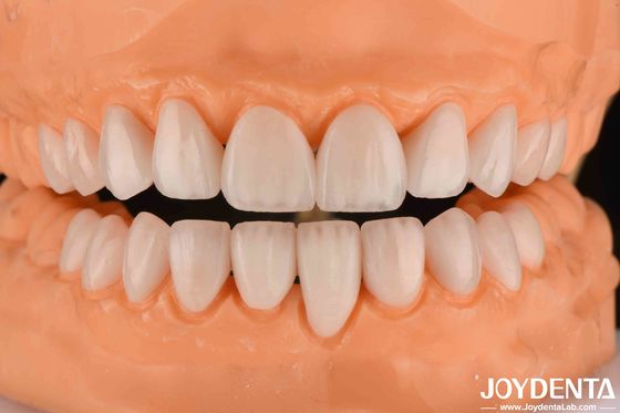 Beli Ceramic Emax Veneers 0.3-0.5mm Ketebalan Panjang Panjang Kosmetik Porselen Veneers pembuatan online