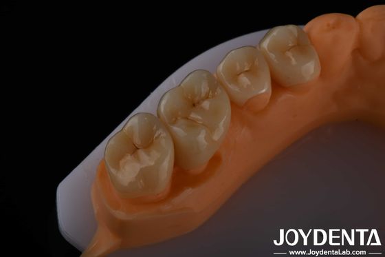 Beli Estetika Tinggi Zirconia Full Contour Untuk Mahkota Jembatan Implan Restorasi Gigi pembuatan online