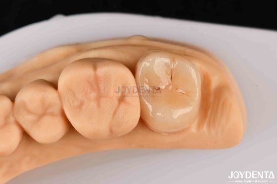Beli Kekuatan tinggi Emax Inlay Onlay A2 Warna tahan lama untuk restorasi gigi yang rusak pembuatan online