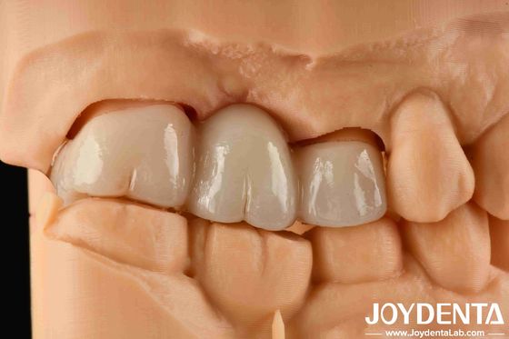 Beli Pengalaman Warna Realistis Zirconia Penuh Dengan Ketahanan Tinggi terhadap Pewarnaan Dan Kekuatan Lipat 1000 MPa pembuatan online