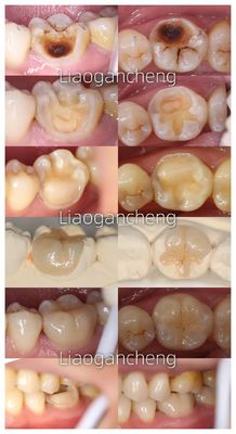 Beli Inlay Gigi Porselin Restoratif Untuk Dewasa Dan Anak-anak Kinerja Luar Biasa pembuatan online