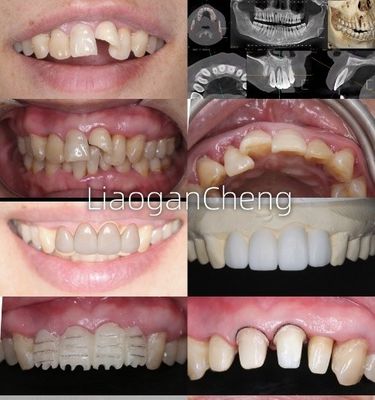 Beli Biokompatibilitas Mahkota Gigi Zirconia Aman Untuk Restorasi jangka panjang dan yang didukung implan pembuatan online