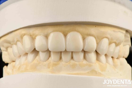 Beli Wax-Up Diagnostik Estetik Biomimetik Veneer Gigi pembuatan online