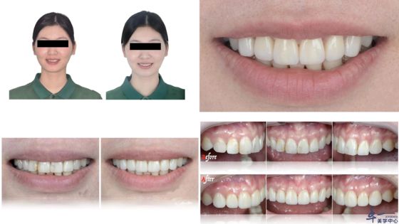 Beli Produk populer Joydentalab: veneer estetika simulasi pembuatan online