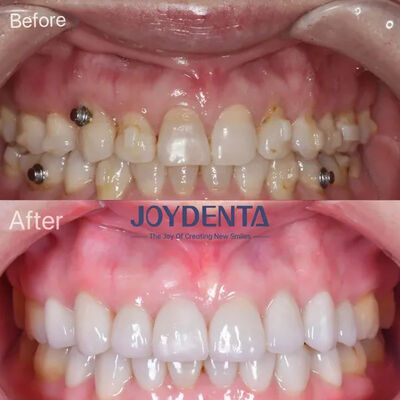 Beli Veneer Gigi untuk Gigi yang Hilang. Global Premium Dental Lab Services pembuatan online