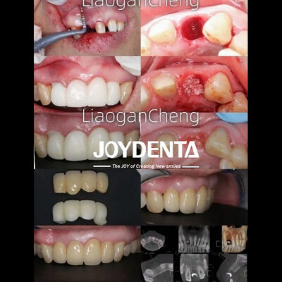 Beli Teknologi Gradient Multilayer Dental Zirconia Aman pembuatan online