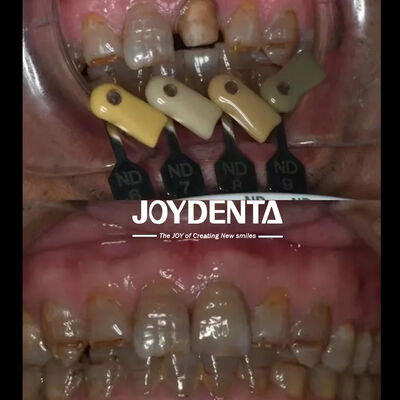 Beli Translucence Zirconia Mahkota Teknologi Gradien Multilayered pembuatan online