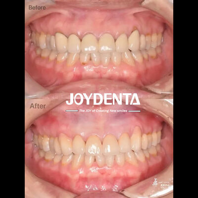 Beli Zirkonia Gigi untuk Jaringan Mulut yang Aman dan Kompatibilitas CAD / CAM pembuatan online