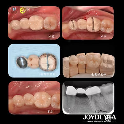 Beli Tailored Dental Zirconia Crown Biokompatibilitas kenyamanan kustomisasi untuk pengalaman pasien yang optimal pembuatan online