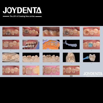 Beli Dewasa Anak-anak Inlay Gigi Keramik Porselen Restoratif untuk Gigi yang Rusak pembuatan online