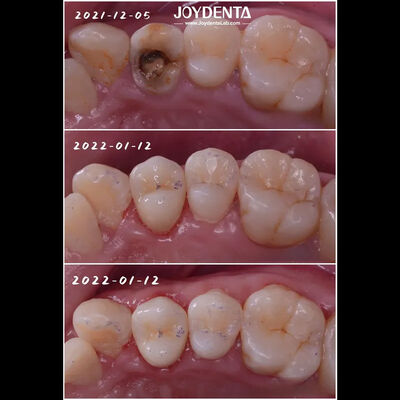 Beli Inlay Porselen Gigi yang Tepat Restorasi Gigi yang Rusak untuk Dewasa dan Anak-anak pembuatan online