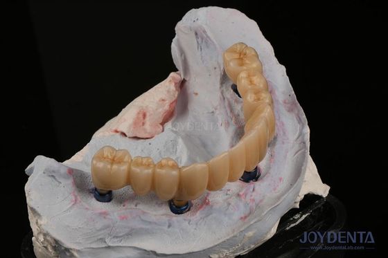 Restorasi Gigi Implantasi Gigi Multiple Endosus Ganti Dua Gigi Depan