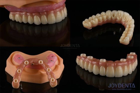 Dental Multiple Teeth Replacement Implantasi permukaan kasar Komponen prostetik