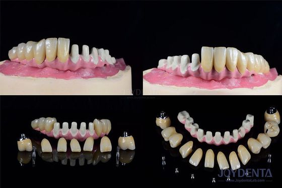 Implan Gigi Endosseus Multiple Sambungan Internal Untuk Restorasi Lengkungan Penuh