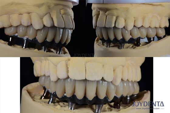 Titanium Multiple Teeth Dental Implant Prosthetic Surgery Eksternal Hexagon Connection