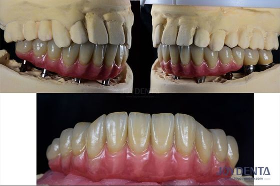Rekonstruksi Gigi Implan Gigi Multiple Titanium Protesis Koneksi Internal