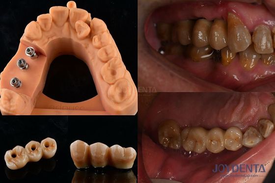 Ultra Hard Color Stability Dental Implant Crown OEM Mudah Dipertahankan Lama