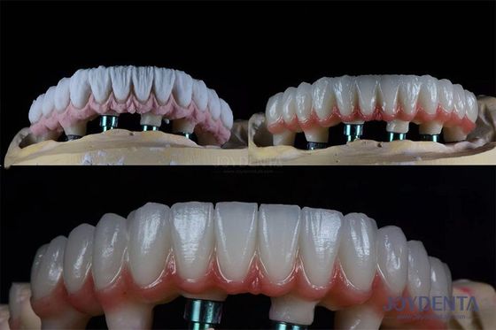 10mm Multiple Teeth Two Stage Dental Implant Kit Untuk Mahkota Prosthetic Endosum