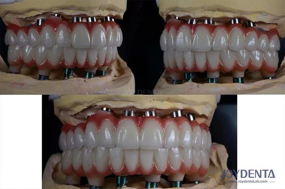 10mm Titanium Multiple Teeth Implant Permukaan kasar untuk restorasi gigi