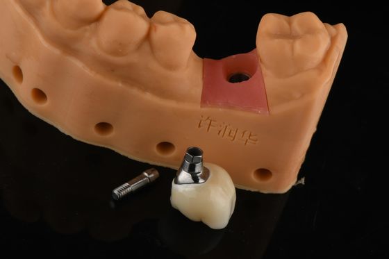 Precision Cylindrical Silver Single Tooth Replacement Implantasi Restorasi Gigi