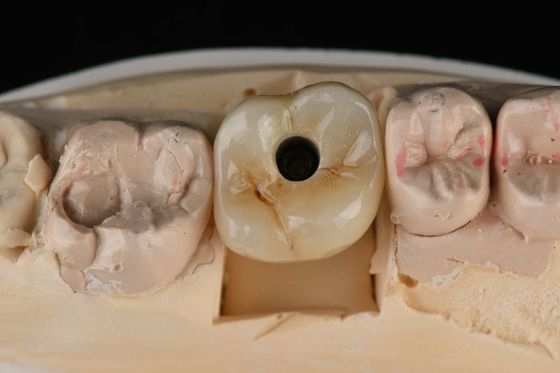 Titanium 10mm Single Tooth Implan Gigi Penggantian Abutment Self Tapping Sandblasted