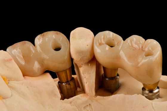 Self Tapping 3.0mm Thread Dental Titanium Implant Optimized Fungsionalitas