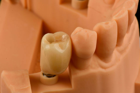 Internal Hex Connection Sandblasted Titanium Dental Implants Penggantian Gigi Tunggal