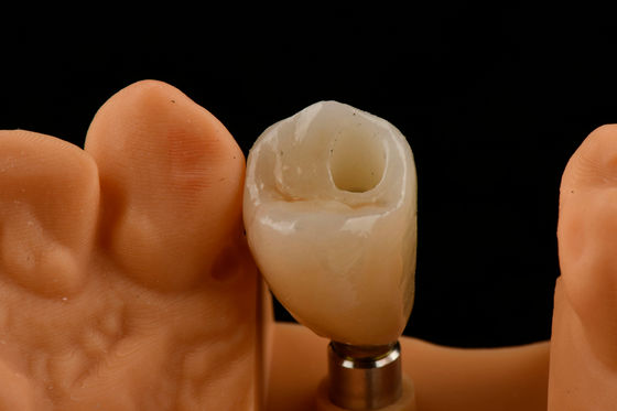 Titanium Single Tooth Implan Gigi Jenis Sambungan Hex Internal Untuk Pas Optimal